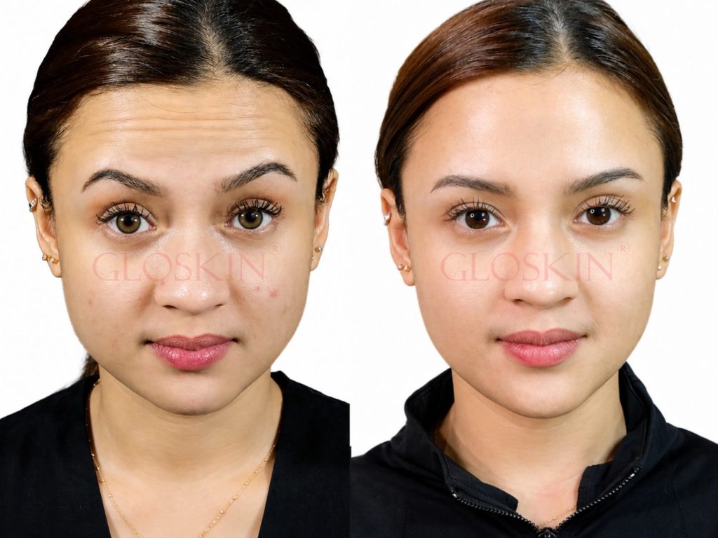 Botox