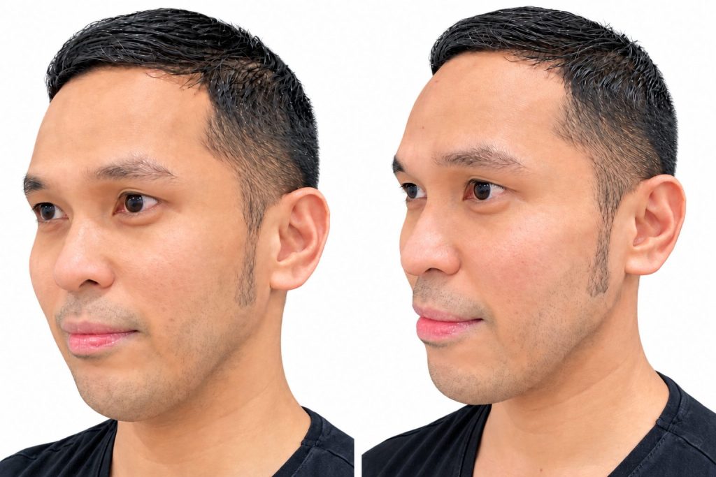 Face Contour Juvederm