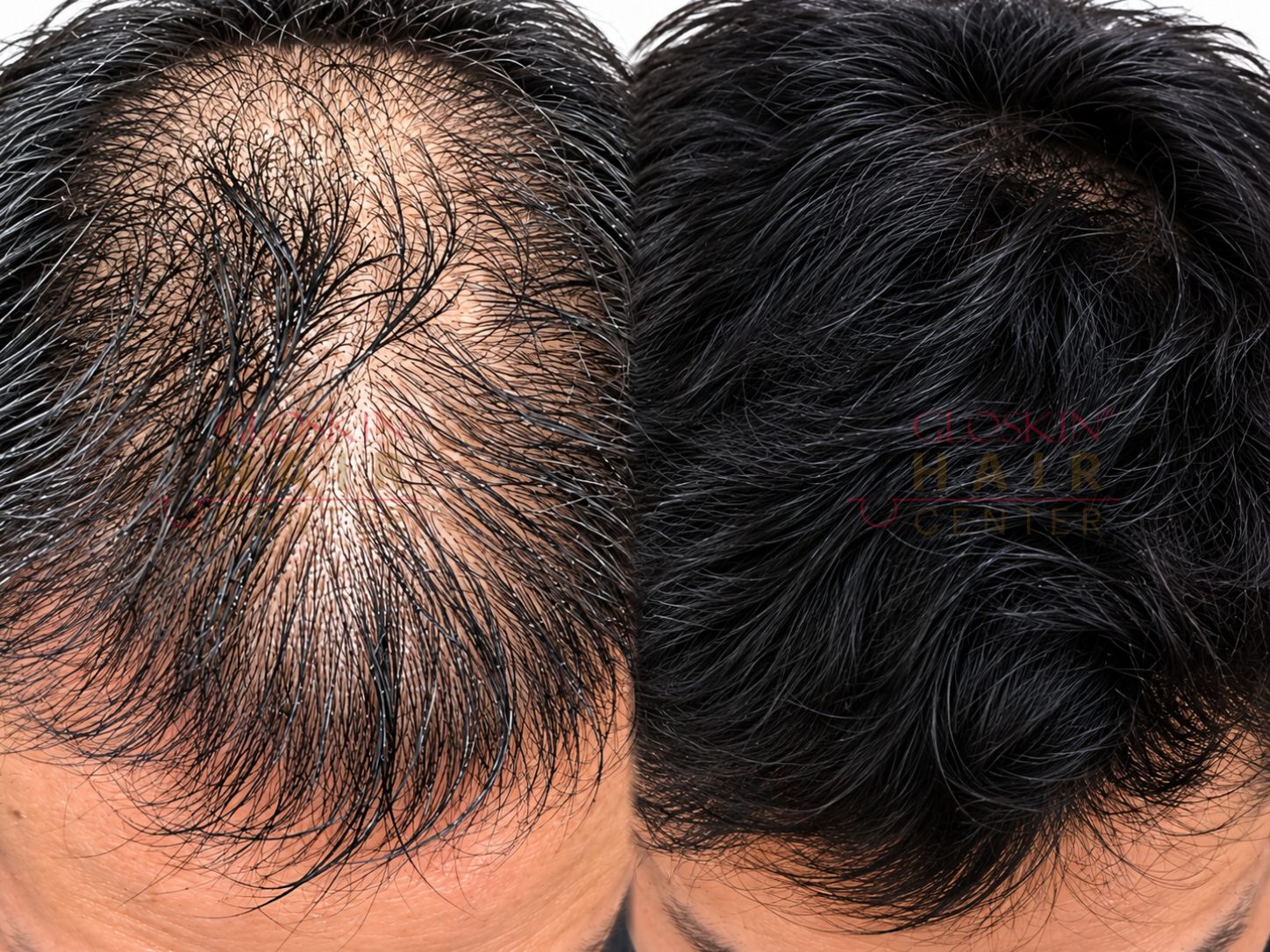 Hair PRP