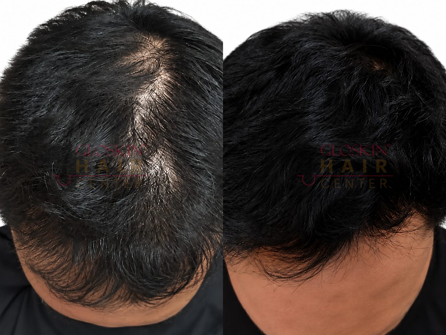 Hair PRP