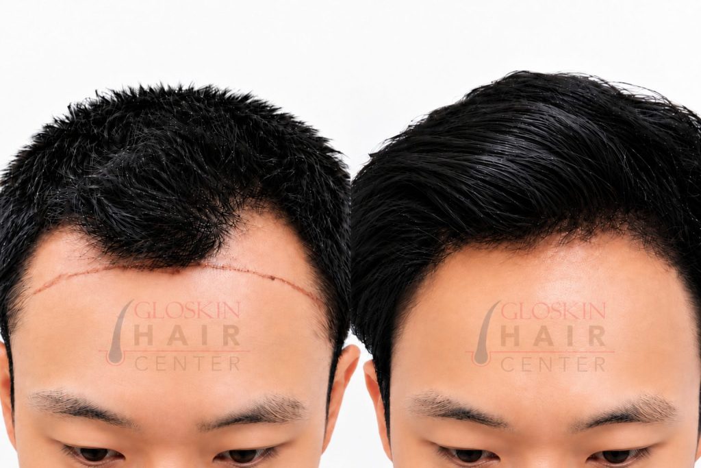Hair Transplant