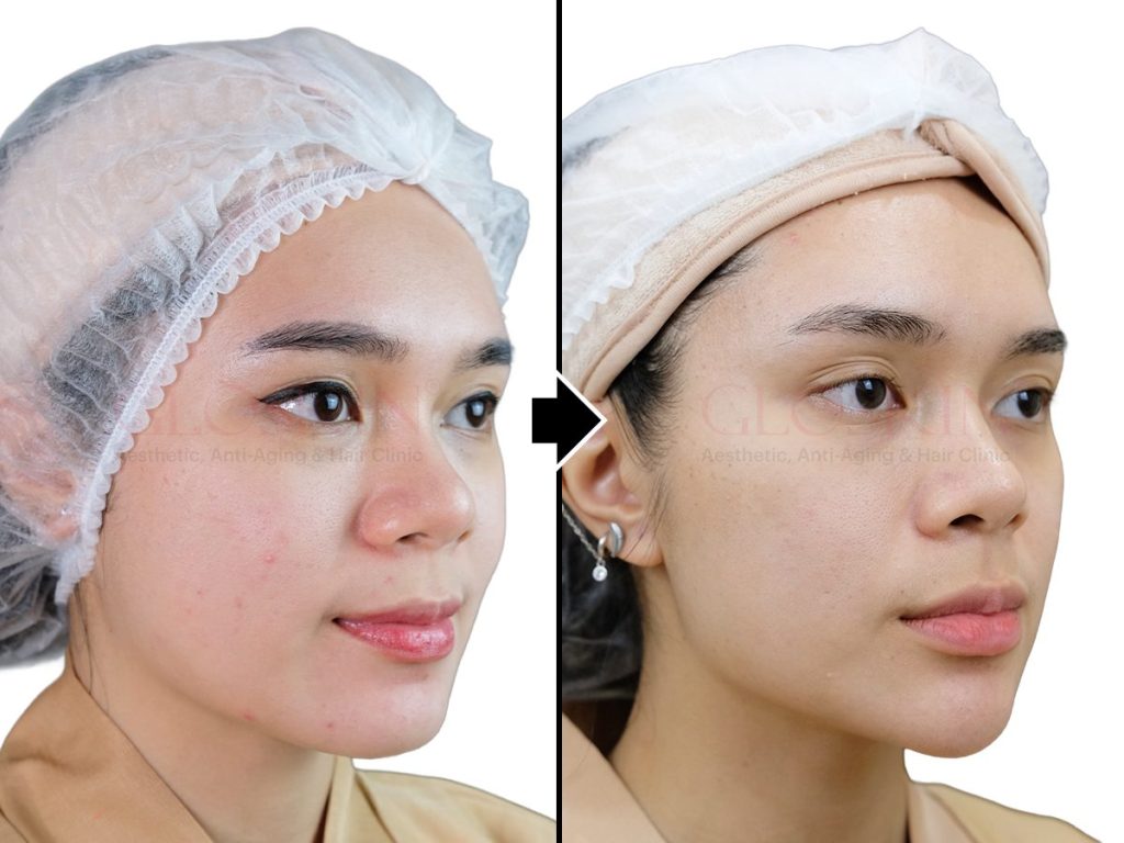 Jawline Shaping