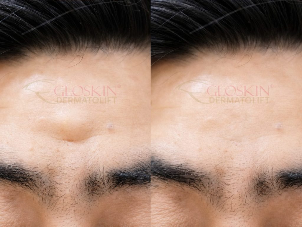 Lipoma Removal