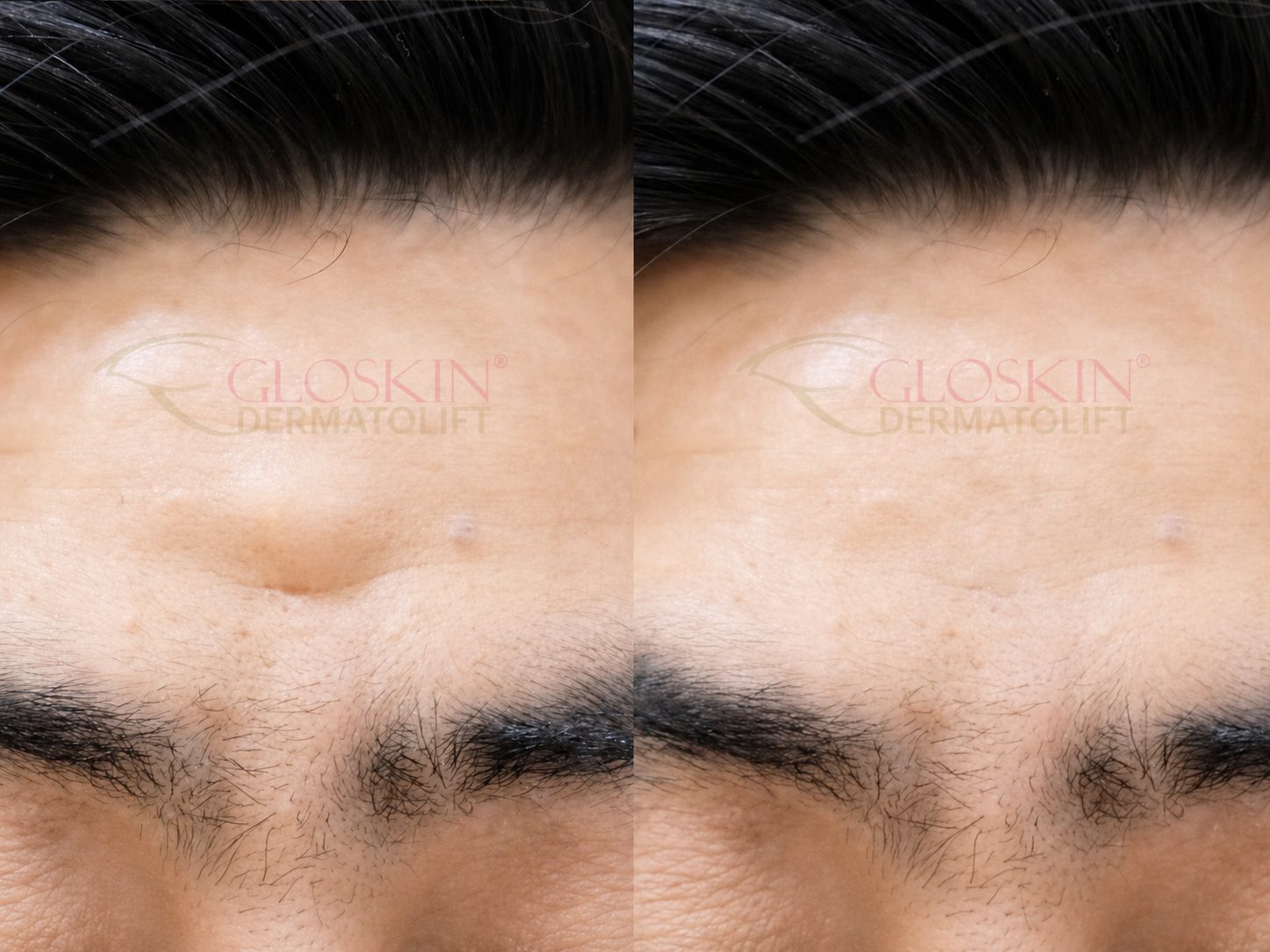 Lipoma Removal