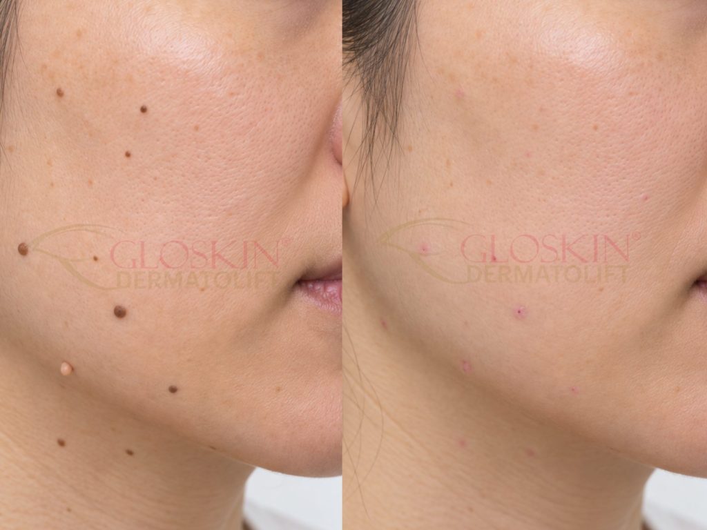 Skin Tumor Removal