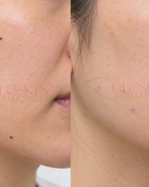 Skin Tumor Removal