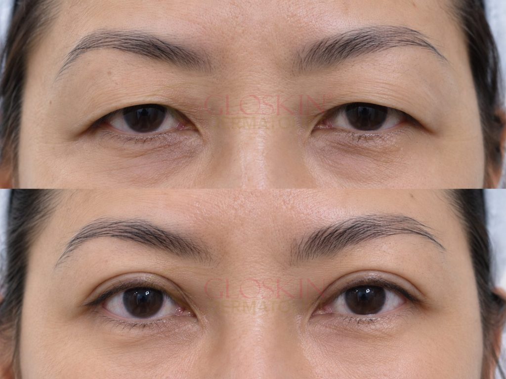 Upper Eyelid
