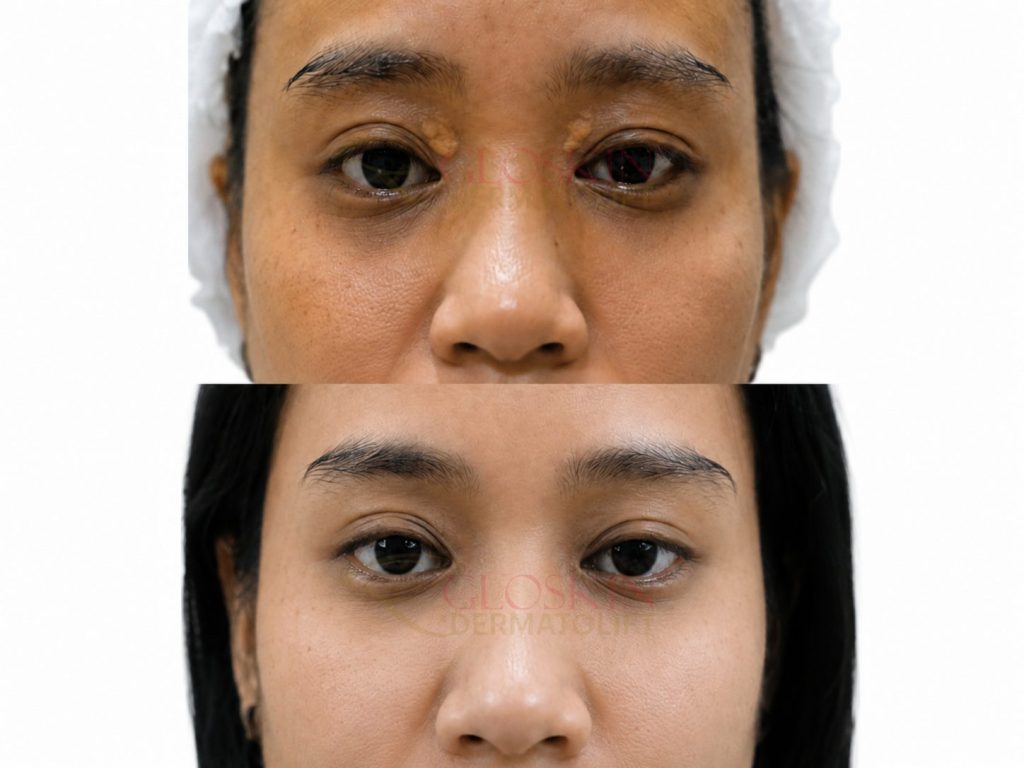 Xantelasma
