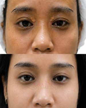 Xantelasma